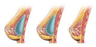 Збільшення грудей імплантами
